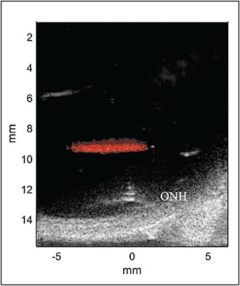 Figure 4. Image of ultrasound-activated nanodroplets in posterior vitreous of an ex vivo pig eye. An 18 MHz linear array was used for imaging and activation of nanodroplets in the probe&#x2019;s focal plane. Nanodroplets, measuring approximately 100 nm in diameter, have a perfluoropentane core and lipid shell. The core undergoes a phase transition from liquid to gas when exposed to focused ultrasound at acoustic intensities just above diagnostic levels, minimizing thermal effects.