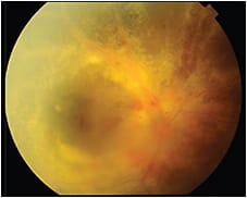 Figure 2. Two weeks after repeated intravitreal injections of ganciclovir alone; the patient later developed retinal detachment. The other eye developed CMV retinitis 6 months later.