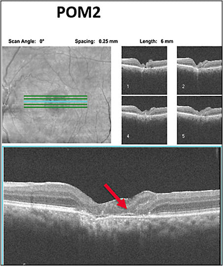 Figure 4. Optical coherence tomography 2 months after retinal patch graft surgery showing outer retinal structures.