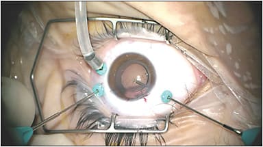 Figure 5. Posterior capsulotomy at the time of primary vitrectomy.
