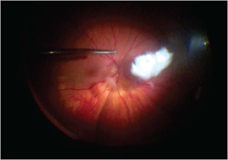 Figure 2. In this eye that underwent cataract surgery 1 week prior, the bi-blade cutter (Bausch + Lomb) was used to induce a posterior vitreous detachment, and it efficiently removed both retained nuclear and cortical material.
