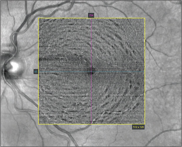Figure 1. En-face optical coherence tomography image of patient with a “moth-eaten” appearance characteristic of dissociated optic nerve fiber layer, with arcuate dimpling occurring 2 months following internal limiting membrane peel for a macular hole.