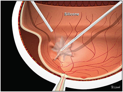 Figure 1. Proliferative vitreoretinopathy reoperation “under” silicone, forceps membrane peeling using Alcon DSP ILM forceps. Oil is infused using an Alcon viscous fluid control and MedOne silicone oil infusion cannula connected via a nonvalved cannula. IMAGE CREATED BY BYRON WOOD, GRAPHIC DESIGNER AND MEDICAL ARTIST WITH CHARLES RETINA INSTITUTE.