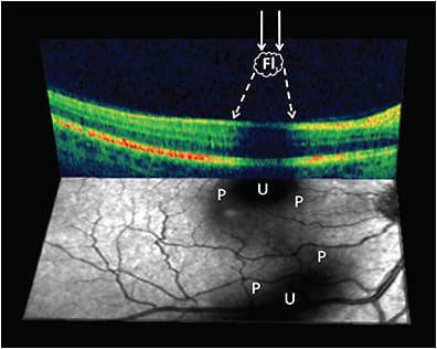 Figure 6. Combined optical coherence tomography and scanning laser ophthalmoscopy (SLO) imaging demonstrates vitreous opacity-induced attenuation (darkness) of retinal imaging, especially at the retinal pigment epithelium/Bruch’s membrane interface. The dark areas on the greyscale SLO image (lower portion) are “shadows” cast by vitreous opacities. Solid arrows represent incident light rays, while dashed arrows represent scattered light. Fl, vitreous opacity; U, umbra; P, penumbra.