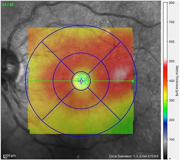 Figure 3. At 11 months of follow-up, the patient’s vision improved from 20/100 to 20/80.