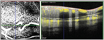 Figure 4. Segmentation artifact causes the vessels to appear as abruptly ending in one layer and then reappearing in another layer (OCTA en face image, A; B-scan with OCTA flow information overlaid in yellow, B). This is often seen in eyes with pathology, especially those with obliteration of the normal retinal layers, such as in this retinoblastoma.