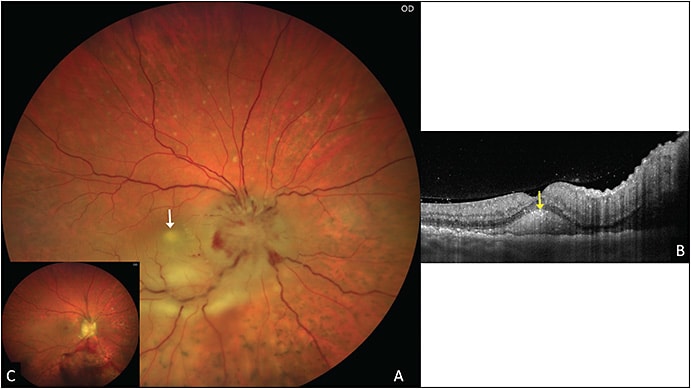 Figure 2. A 52-year-old male patient presented with chronic relapsing subretinal infiltrates (white arrow), and uveitis workup was unrevealing (A)