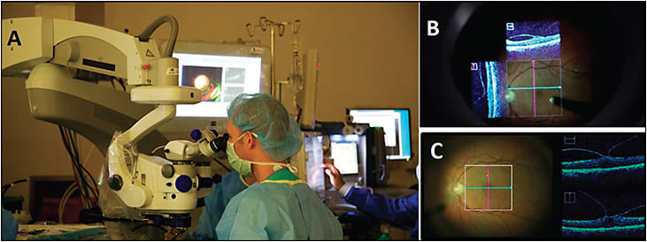 Figure 1. A surgeon using the Zeiss RESCAN 700 system. Note that the surgeon is looking into the microscope while the OCT is also displayed on the monitor (A). An example of the surgeon view (B). An example of the screen view (C).