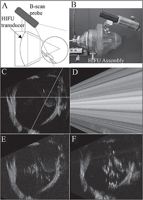 Figure 3. Ultrasound-guided high-intensity (4.7 MHz) ultrasound (HIFU) treatment of simulated vitreous hemorrhage in ex vivo pig eye. Schematic of HIFU assembly (A). Focal region is imaged by B-scan probe. Photograph of assembly (B). B-scan with HIFU beam profile superimposed (C); HIFU focal point is within blood-mass near posterior pole. During HIFU, B-scan image is lost due to interference from HIFU (D). Disrupted hemorrhage after 1-second exposure (E). Further disruption and coagulation after second expo