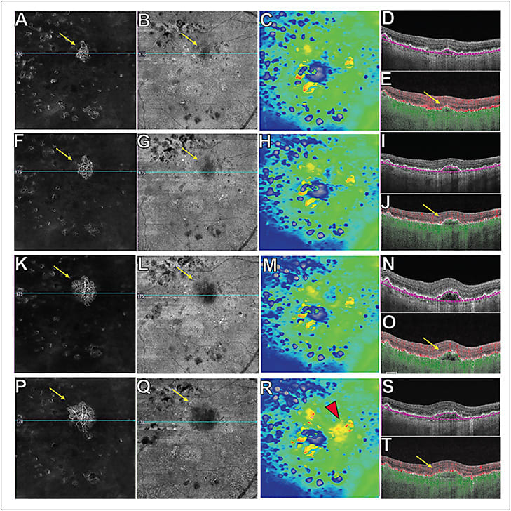 Figure 1. Swept-source optical coherence tomography angiography (SS-OCTA) scans (6x6 mm; Zeiss Plex Elite 9000) of an asymptomatic eye from a patient with nonexudative, subclinical neovascular age-related macular degeneration that required aflibercept therapy after 10 months of observation. First column (A, F, K, and P): en face SS-OCTA flow images with projection artifacts removed and the corresponding horizontal B-scan represented by a blue line through type 1 macular neovascularization (MNV; yellow arrow) showing progressive growth of the neovascular complex. Second column (B, G, L, and Q): en face SS-OCTA structural images and the corresponding horizontal B-scan represented by a blue line through type 1 MNV (yellow arrow) seen as a dark signal on structural images. Third column (C, H, M, and R): thickness map images with orange and yellow colors showing increased thickening in panel R. Fourth column (D, E, I, J, N, O, S, and T): horizontal B-scans with or without segmentation lines and color-coded flow. Red color represents flow in the retina and the green color represents flow beneath the retinal pigment epithelium (RPE). Boundary specific segmentation lines (RPE-RPE fit) for type 1 MNV are depicted by dotted purple lines. Last row (P, Q, R, S, and T): Images show growth of the type 1 MNV with exudation as seen on the thickness map (panel R) as increased thickening that corresponded to new intraretinal fluid (red arrowhead). The patient was symptomatic at this visit and intravitreal aflibercept was injected.