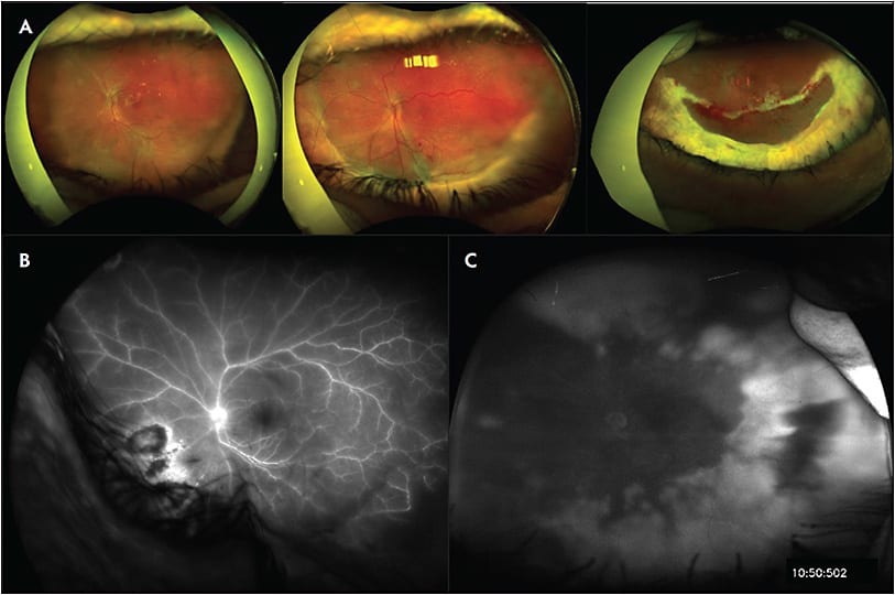 Figure 2. Infectious retinitis secondary to herpes-zoster virus, complicated by cicatrizing disease and rhegmatogenous retinal detachment (A). Fluorescein angiogram of a patient with toxoplasma chorioretinitis (B) compared to that of a patient with herpetic retinitis (C).