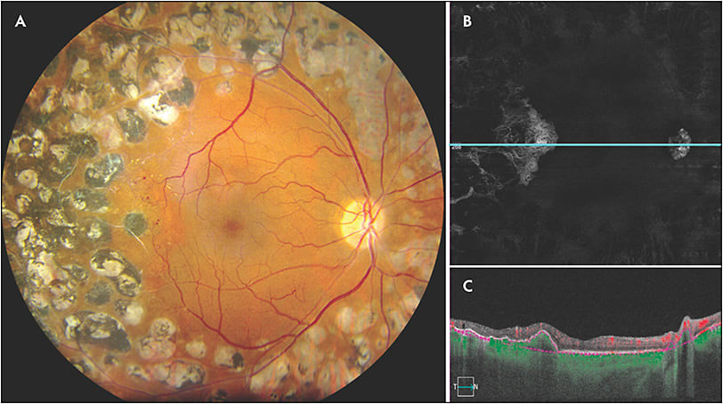 Figure 3. Fundus photo showing dense laser in a patient with proliferative diabetic retinopathy (A). Swept-source optical coherence tomography angiography (Plex Elite 9000; Carl Zeiss Meditec) retinal pigment epithelium-Bruch’s slab of 12 mm x 12 mm scans showing choroidal neovascularization associated with the laser scar (B, C).