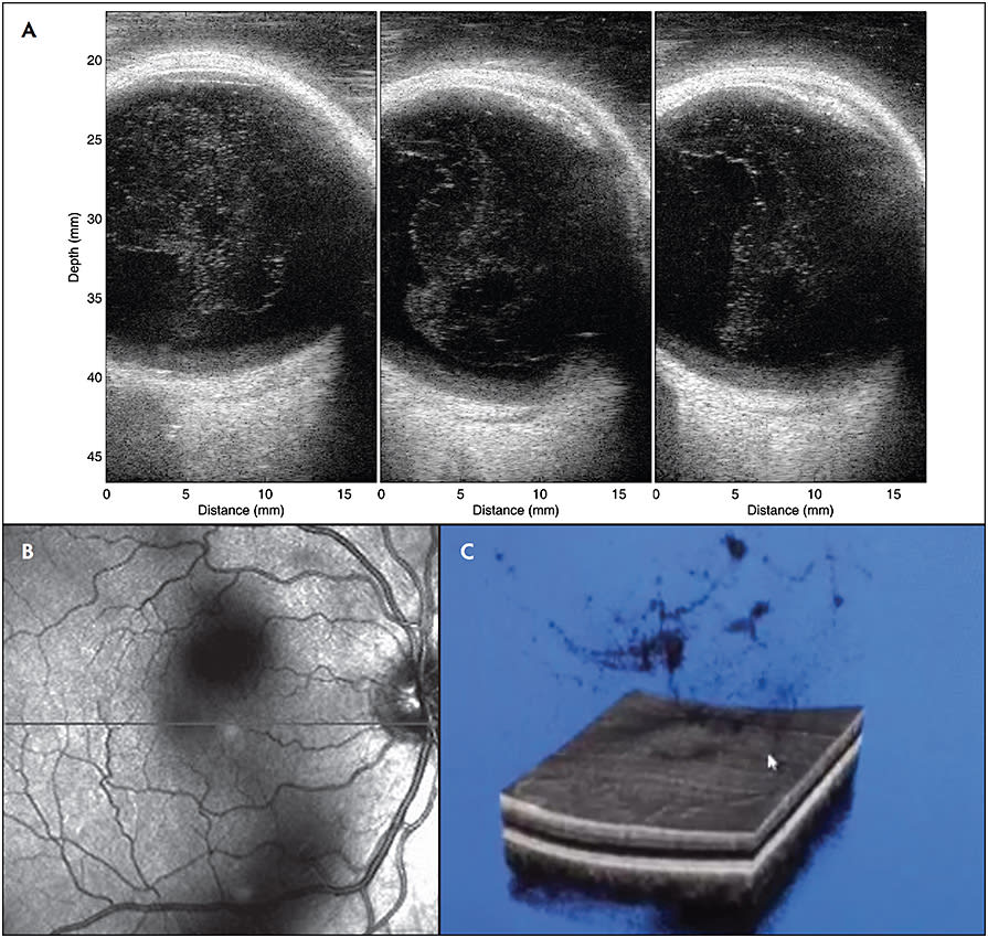 Figure 4. Myopic vitreopathy. Ultrasound imaging with 20 MHz annular array with chirp pulse encoding demonstrates increased vitreous body echodensity, as well as PVD (A). Reprinted with permission from Sebag J, ed. Vitreous in Health and Disease. Springer; 2014:21. Scanning laser ophthalmoscopy of fundus shadowing by vitreous opacification due to myopic vitreopathy (B). Reprinted with permission from Sebag J, ed. Vitreous in Health and Disease. Springer; 2014:777. 3D OCT