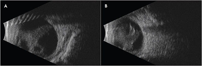 Figure 1. Familiar exudative vitreoretinopathy. This patient with LRP5 mutation presented with a retinal fold OD and avascular retina OU. He underwent laser photocoagulation in both eyes, but eventually required a vitrectomy with membrane peel in the right eye for a tractional retinal detachment. He was stable for 5 years prior to being lost to follow-up. Photos A and B demonstrate findings at his last visit.