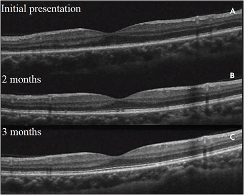 Figure 7. Multiple evanescent white dot syndrome. On presentation, optical coherence tomography (Heidelberg Spectralis) shows broad ellipsoid zone and external limiting membrane hyporeflectivity in the area of whitening in the acute phase (A). Two months later, there is significant resuscitation of the normal ellipsoid zone (B). Three months after initial presentation, there is essentially complete recovery of the ellipsoid zone (C).