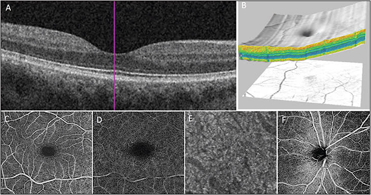 Figure 1. SD-OCT images of a normal macula showing various options for image analysis. Cross-sectional B-scan image showing the retinal layers (A). Macular surface map generated from 3-dimensional reconstruction of the macula showing normal foveal contour (B). 6 mm x 6 mm en face OCTA slabs of the macula showing normal retinal vascular flow through the superficial retinal vascular plexus (C), deep retinal vascular plexus (D) and choriocapillaris (E). OCTA of peripapillary vascular network (F).