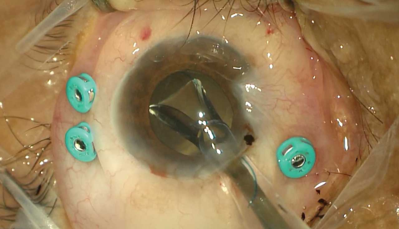 Figure 2. In complex cases a 3-piece intraocular lens may help minimize shifts in intraocular lens position during and after surgery.