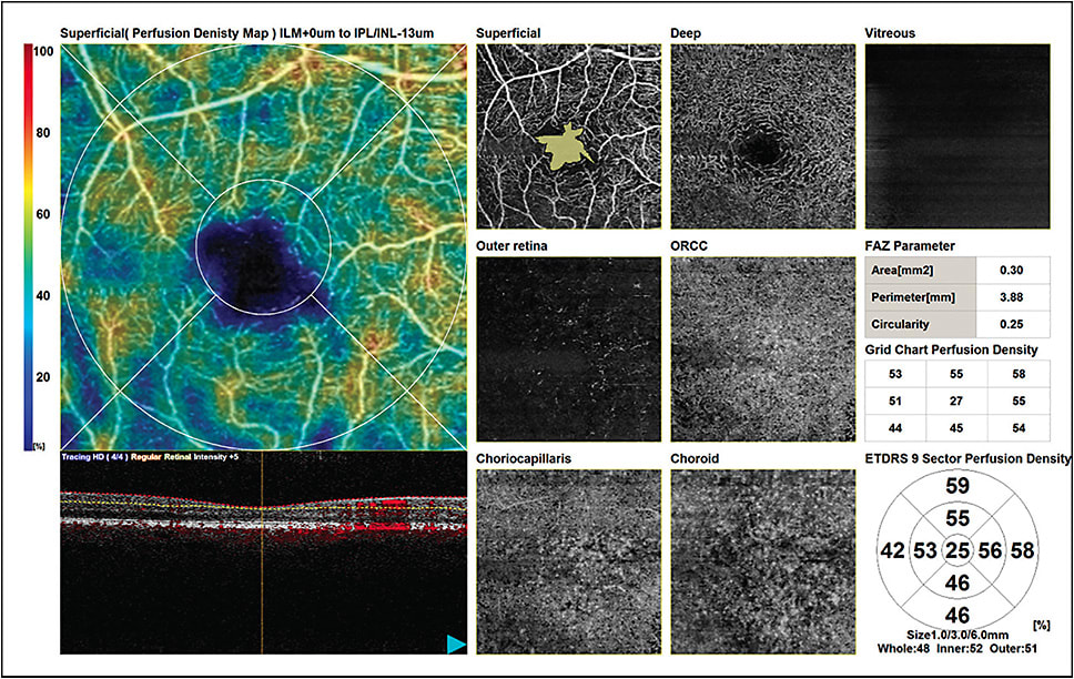 Figure 3. OCT angiography shows an enlarged foveal avascular zone in a patient with diabetes but no overt evidence of diabetic retinopathy.
Images courtesy of Nadia Waheed, MD, MPH