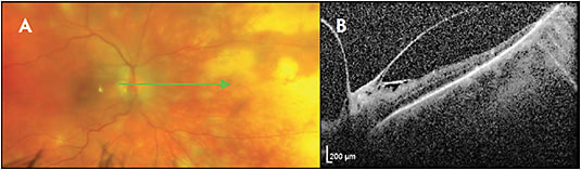 Figure 5. Acute retinal necrosis. Fundus photo (A) shows initial presentation, and optical coherence tomography (B) shows the area 2 months later, after treatment. On optical coherence tomography (Heidelberg Spectralis) there is severe thinning and loss of identifiability of the outer retinal layers, as well as vitreopapillary adhesion.
