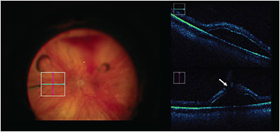 Figure 3. Intraoperative OCT (Zeiss Rescan 700) detection of subclinical small retinal detachment with associated retinal break (white arrow).