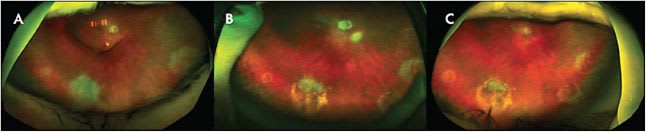 Figure 1. Wet age-related macular degeneration (wet AMD) on optical coherence tomography angiography (OCTA)