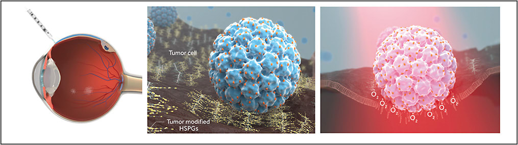 Figure 1. Virus-like drug conjugates are delivered through suprachoroidal injection (right) and bind to specifically modified HSPGs on the tumor cell surface (central). When virus-like drug conjugates are activated by 689-nm near infrared light laser, they generate singlet oxygen that disrupts the tumor cell membrane and lead to acute necrosis and anti-tumor immunity.