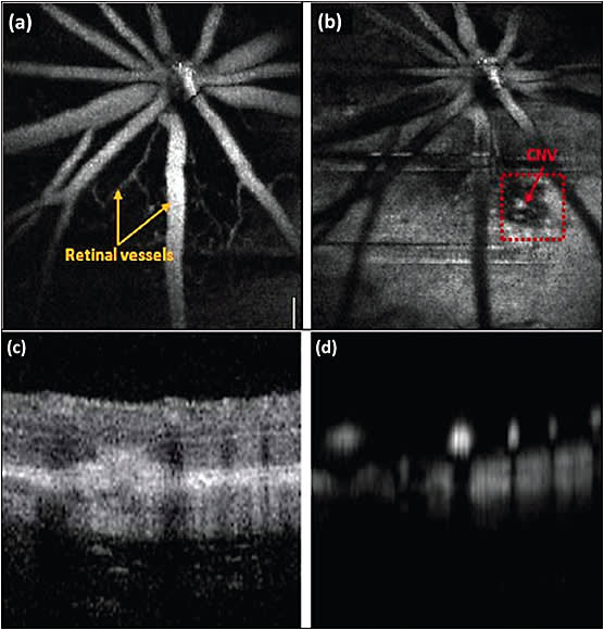 Figure 2. Photoacoustic microscopy (PAM) of choroidal neovascularization in mice: Two-dimensional en face image of anterior retinal structure (A). Photoacoustic microscopy image of the laser induced choroidal neovascularization regions (B). Red arrows point to the choroidal neovascularization region. B-scan optical coherence tomography (C) and B-scan PAM (D). Choroidal neovascularization bar: 100 μm2