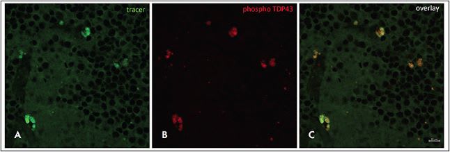 Figure 1. The retinal tracer AMDX-2011P was developed by Amydis and is in clinical testing for amyotrophic lateral sclerosis (ALS).