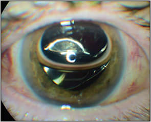 Figure 1. Postoperative day 1 following scleral fixation of an enVista MX60 lens (Bausch + Lomb) and retinal detachment repair.
IMAGE COURTESY OMESH GUPTA MD, MBA