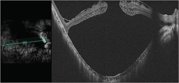 Figure 2. A 58-year-old male with an axial length of 29.40 mm in the right eye presented with progressively decreasing vision and was found to have a macular hole with associated retinal detachment. The patient underwent pars plana vitrectomy, internal limiting membrane peeling, fluid-air exchange, and placement of C3F8 gas. The patient’s retina remained attached with closed macular hole at 13-month follow-up. Photo courtesy of Steven Sanislo, MD, Stanford University.