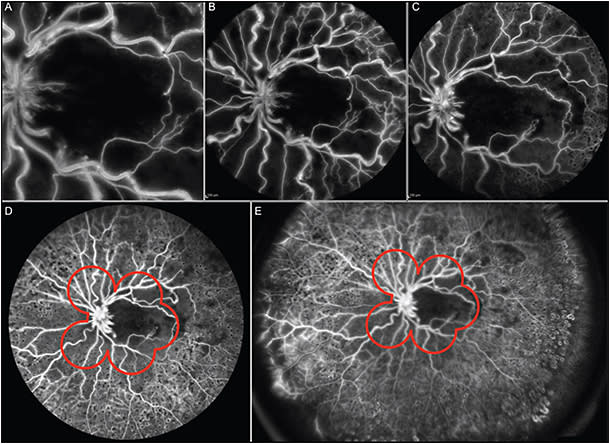 Figure 3. Fluorescein angiography in a patient with retinal vein occlusion: 30° (A), 55° (B), 60° (C), 120° (D), and 150° (E). Red outline shows the 7-field view.