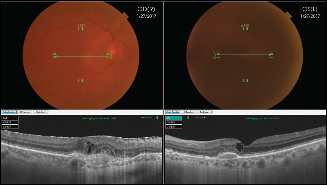 Figure 3. Swept-source 1,050 nm light source penetrates media opacities. Bilateral choroidal neovascular membranes secondary to angioid streaks. In the left eye, despite a brunescent cataract, the longer 1,050 nm wavelength highlights the choroidal details.