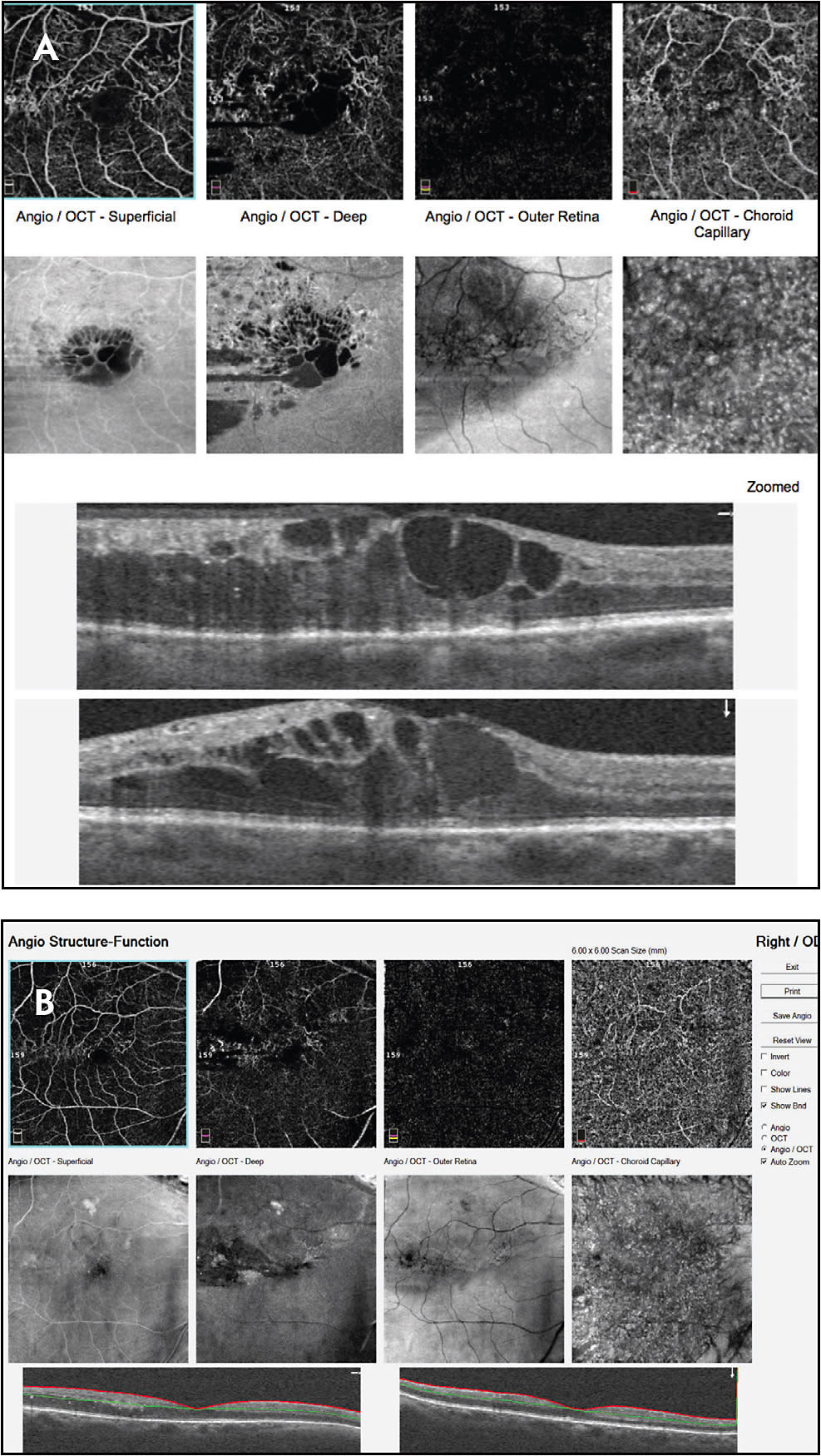 Figure 2. OCTA in an eye with branch retinal vein occlusion showing irregular perifoveal tortuous vessels in the superficial and deep capillary plexus. Cystoid macular edema is evident on the structural OCT B scan and en face images. Note the black ovoid spaces in the deep slabs demonstrating macular edema (A). Four days after anti-VEGF injection, the intraretinal cysts have resolved on the OCTA and structural OCT B scan (B).