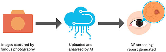 Figure 3. In artificial intelligence diabetic retinopathy screening, color photographs are taken with a fundus camera and uploaded to the cloud, where the AI algorithm analyzes the images for signs of diabetic retinopathy and reports whether diabetic retinopathy is detected.