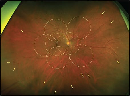 Figure 1. Ultrawidefield color image shows diabetic retinopathy lesions (yellow arrowheads) predominantly peripheral to the Early Treatment Diabetic Retinopathy Study fields (dotted white circles).
