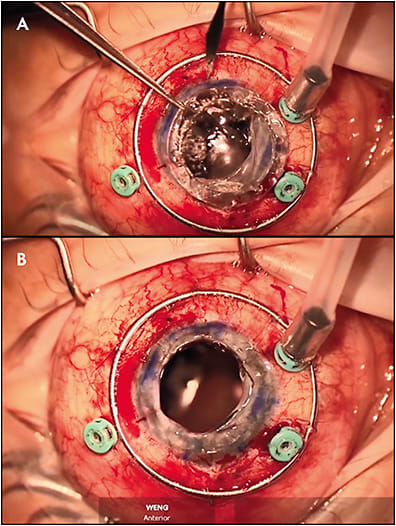 Figure 3. Once temporary keratoprosthesis was removed (A), the aphakic eye was open sky with no cornea in place, filled with only air (B). Note the visualization of the optic nerve and endolaser below.