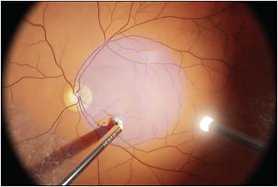 Figure 1. Vitreoretinal surgery simulated with the Eyesi simulator (Haag-Streit). Image courtesy of Haag-Streit.