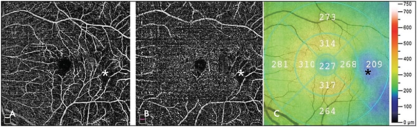 Figure 3. Optical coherence tomography angiography shows decreased vascular density (asterisk) in the superficial capillary plexus (A) and deep capillary plexus (B) in a patient with homozygous sickle cell disease. Areas of vascular loss correspond to temporal macular thinning (C; asterisk) shown on the heat map.