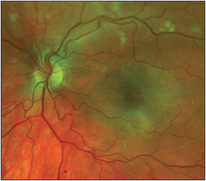 Figure 1. Radiation retinopathy seen on Optos imaging.