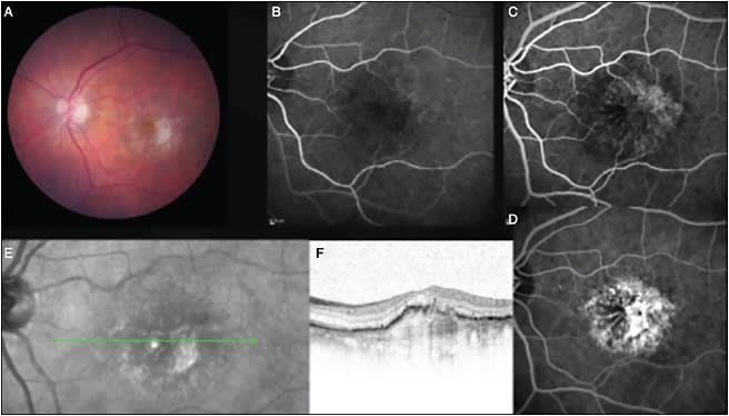 Figure 2. Images from a patient with neovascular AMD in the left eye who presented with an active choroidal neovascularization that was accompanied by fibrosis. Color photograph shows central fibrosis (A). Fluorescein angiography demonstrates leakage from a neovascular membrane appearing early, with late staining due to fibrosis (B-D). Near infrared image (E) and optical coherence tomography scan (F) show the membrane with accompanied fibrosis.