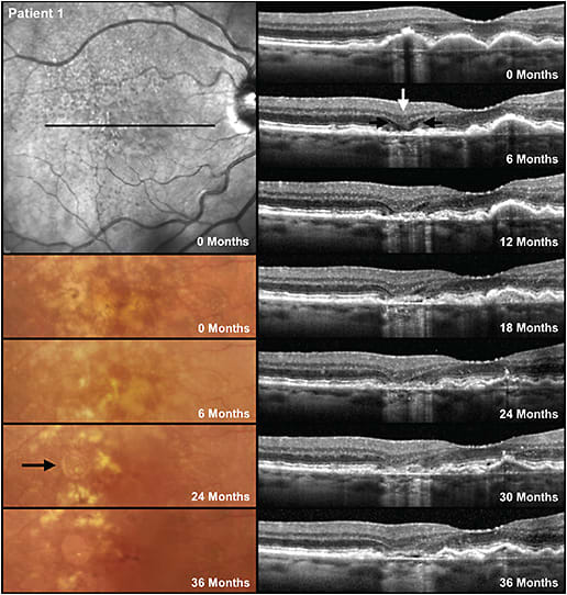 Figure 2. Images from the right eye of a participant in a study with large drusen at baseline