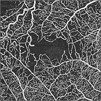 Figure 8. Swept-source optical coherence tomography angiography (Plex Elite 9000; Carl Zeiss Meditec) superficial retina slab of 3 mm x 3 mm scans showing areas of reduced capillary perfusion density in a patient with proliferative diabetic retinopathy.