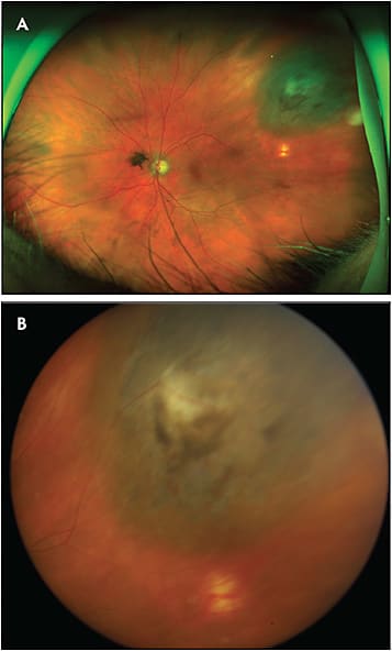 Figure 3. Optos ultrawidefield fundus photography (A) is able to capture nearly the entirety of this peripheral treated choroidal melanoma and its relative location to the posterior pole. The standard fundus photograph (B) cannot capture as much of the lesion and has a poorer focus, but it reveals the lesion in true color.
