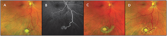 Figure 3. Widefield fluorescein angiography. Solitary retinal capillary hemangioma located in the inferior periphery (A). Fluoresecein angiogram identified the feeder arteriole (B). Appearance immediately (C) and 3 months (D) after laser photocoagulation of the feeder vessel, tumor surface, and the adjacent normal retina.