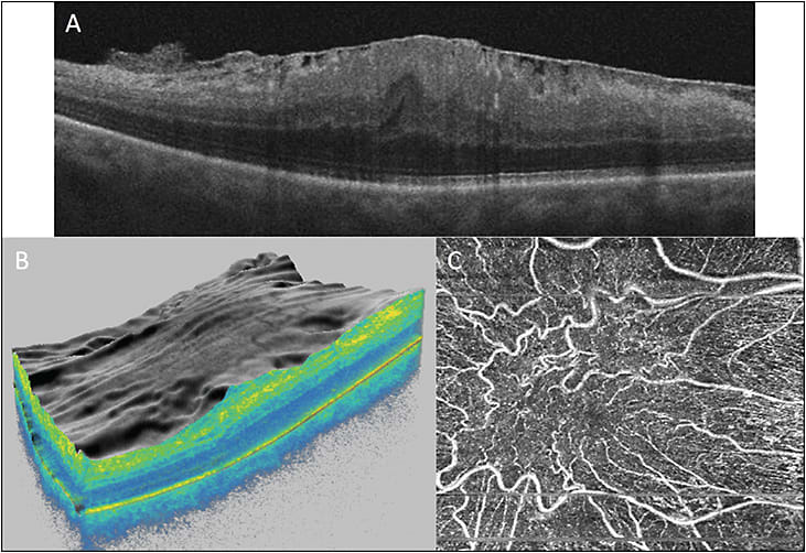 Figure 4. Retinal surface changes associated with epiretinal membrane. SD-OCT B-scan image shows epiretinal membrane and foveal thickening from traction (A); 3D OCT image shows extent of epiretinal membrane and macular traction (B); OCTA of superficial retinal plexus showing traction and distortion of the retinal vessels (C).