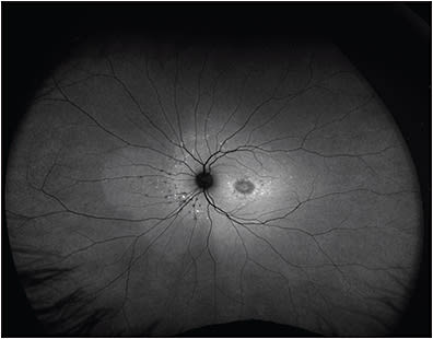 Figure 7. Optos ultrawidefield fundus autofluorescence images of Stargardt disease.