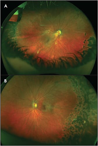 Figure 1. Familiar exudative vitreoretinopathy. This patient with LRP5 mutation presented with a retinal fold OD and avascular retina OU. He underwent laser photocoagulation in both eyes, but eventually required a vitrectomy with membrane peel in the right eye for a tractional retinal detachment. He was stable for 5 years prior to being lost to follow-up. Photos A and B demonstrate findings at his last visit.