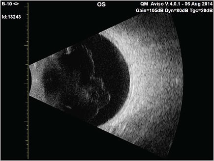 Figure 5. B-scan ultrasonography demonstrates the typical appearance of posterior vitreous detachment. Note that in addition to prominent echoes from the detached posterior vitreous cortex, there are considerable densities within the vitreous body itself. Light scattering by both of these structures likely induces vision-degrading myodesopsia. AVISO ultrasonography unit courtesy of Quantel Medical.