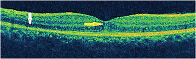 Figure 4. Optical coherence tomography showing subfoveal hyperreflective lesion extending into the outer nuclear layer through disruption of the ellipsoid zone (EZ), interdigitation zone, and external limiting membrane (ELM; yellow arrow) and disruption of ELM and EZ in the parafoveal region (white arrow). Reprinted with permission from Chandrasekaran PR, Kerala J Ophthalmol. 2021;33(2):214-216. DOI:10.4103/kjo.kjo_14_21