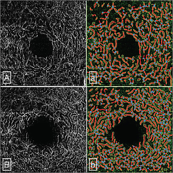 Figure 1. Representative OCTA images from a patient diagnosed with severe COVID. Intermediate capillary plexus (A) and deep capillary plexus (B) en face slabs and their corresponding area of vascularity (a and b, respectively). Vascular density was measured using a semiautomated third-party software that calculates vessel percentage area equivalent to vascular density. Images were retrieved and presented with permission courtesy of Drs. Kalaw and Freeman.